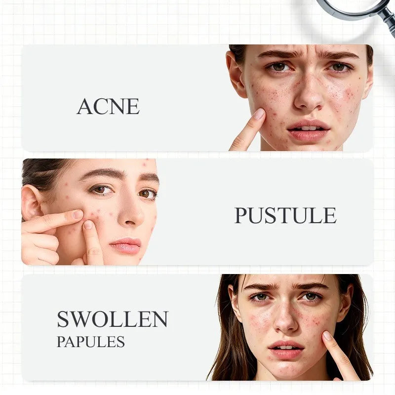 Korean Salicylic Acid Acne Remove Lotion 10ml Reduce Facial Dryness Acne Control Oil Refresh Not Greasy Day&Night Double Repair